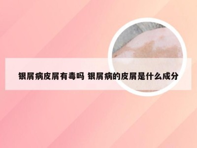 银屑病皮屑有毒吗 银屑病的皮屑是什么成分