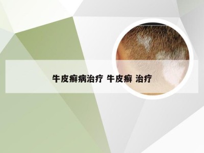 牛皮癣病治疗 牛皮癣 治疗