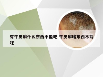 有牛皮癣什么东西不能吃 牛皮癣啥东西不能吃
