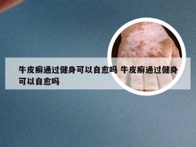 牛皮癣通过健身可以自愈吗 牛皮癣通过健身可以自愈吗