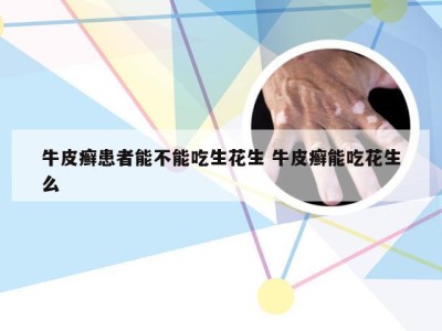 牛皮癣患者能不能吃生花生 牛皮癣能吃花生么