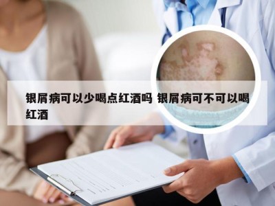 银屑病可以少喝点红酒吗 银屑病可不可以喝红酒