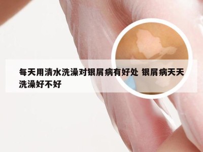 每天用清水洗澡对银屑病有好处 银屑病天天洗澡好不好