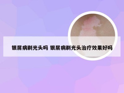 银屑病剃光头吗 银屑病剃光头治疗效果好吗