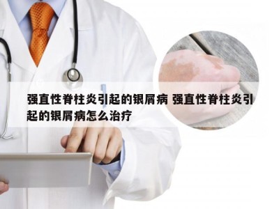 强直性脊柱炎引起的银屑病 强直性脊柱炎引起的银屑病怎么治疗