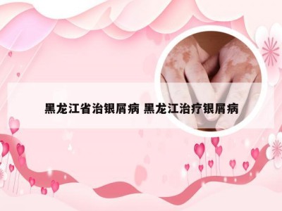黑龙江省治银屑病 黑龙江治疗银屑病