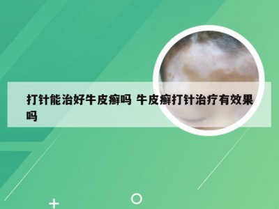 打针能治好牛皮癣吗 牛皮癣打针治疗有效果吗