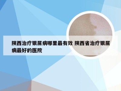 陕西治疗银屑病哪里最有效 陕西省治疗银屑病最好的医院