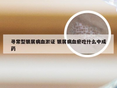 寻常型银屑病血淤证 银屑病血瘀吃什么中成药