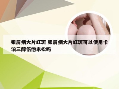银屑病大片红斑 银屑病大片红斑可以使用卡泊三醇倍他米松吗