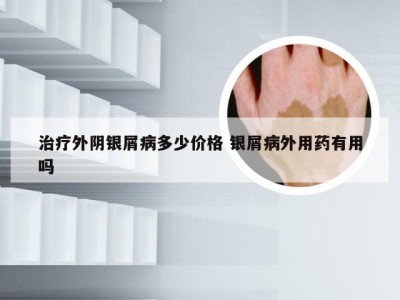治疗外阴银屑病多少价格 银屑病外用药有用吗