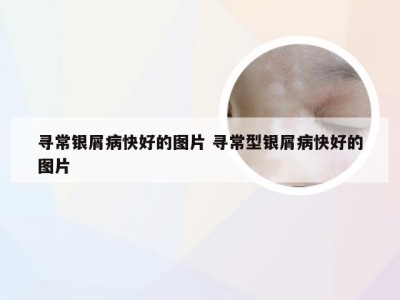 寻常银屑病快好的图片 寻常型银屑病快好的图片