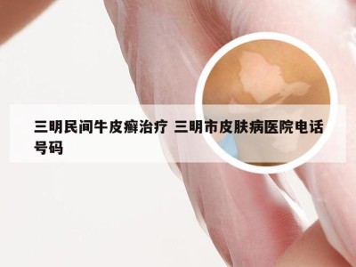 三明民间牛皮癣治疗 三明市皮肤病医院电话号码