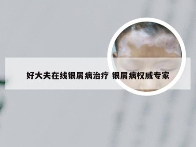 好大夫在线银屑病治疗 银屑病权威专家