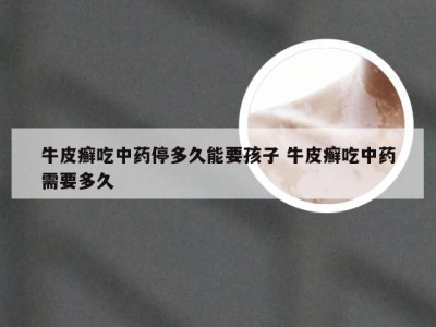 牛皮癣吃中药停多久能要孩子 牛皮癣吃中药需要多久