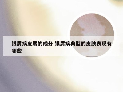 银屑病皮屑的成分 银屑病典型的皮肤表现有哪些