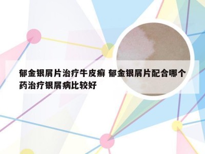 郁金银屑片治疗牛皮癣 郁金银屑片配合哪个药治疗银屑病比较好