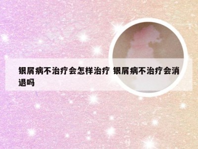 银屑病不治疗会怎样治疗 银屑病不治疗会消退吗