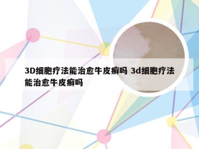 3D细胞疗法能治愈牛皮癣吗 3d细胞疗法能治愈牛皮癣吗