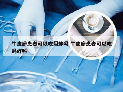 牛皮癣患者可以吃蚂蚱吗 牛皮癣患者可以吃蚂蚱吗