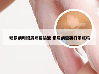 糖尿病和银屑病要输液 银屑病需要打吊瓶吗