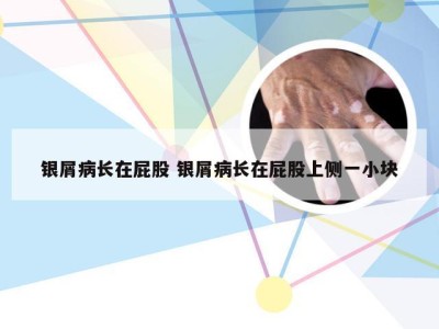 银屑病长在屁股 银屑病长在屁股上侧一小块