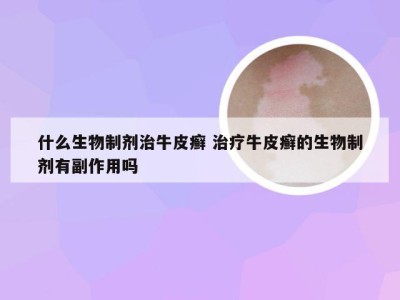 什么生物制剂治牛皮癣 治疗牛皮癣的生物制剂有副作用吗