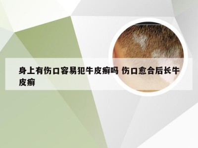 身上有伤口容易犯牛皮癣吗 伤口愈合后长牛皮癣