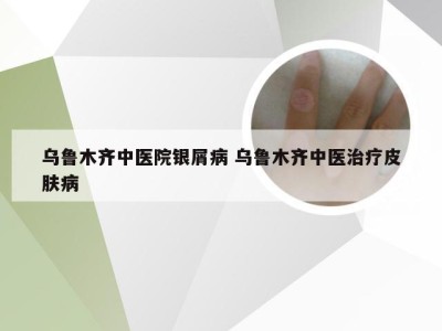 乌鲁木齐中医院银屑病 乌鲁木齐中医治疗皮肤病