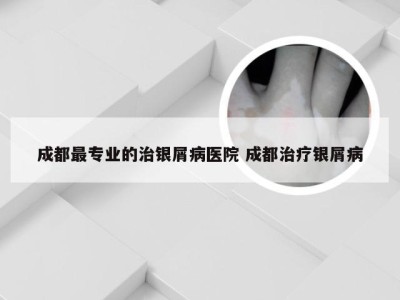 成都最专业的治银屑病医院 成都治疗银屑病