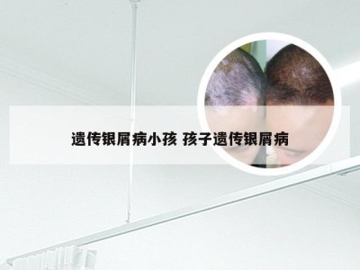 遗传银屑病小孩 孩子遗传银屑病