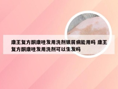 康王复方酮康唑发用洗剂银屑病能用吗 康王复方酮康唑发用洗剂可以生发吗