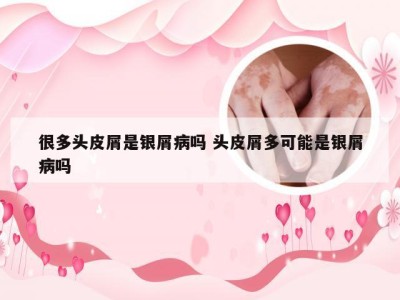 很多头皮屑是银屑病吗 头皮屑多可能是银屑病吗