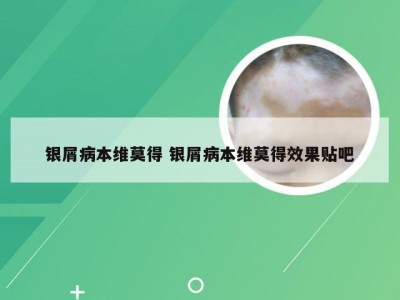 银屑病本维莫得 银屑病本维莫得效果贴吧