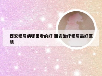 西安银屑病哪里看的好 西安治疗银屑最好医院