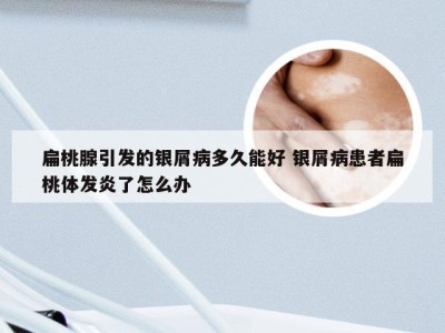 扁桃腺引发的银屑病多久能好 银屑病患者扁桃体发炎了怎么办