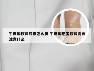 牛皮癣饮食应该怎么样 牛皮癣患者饮食需要注意什么