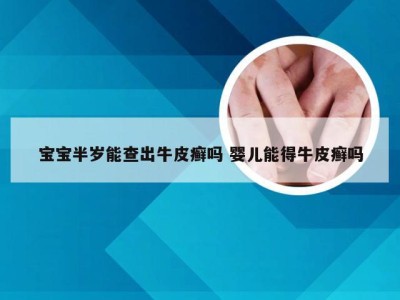 宝宝半岁能查出牛皮癣吗 婴儿能得牛皮癣吗