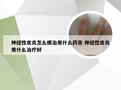 神经性皮炎怎么根治用什么药膏 神经性皮炎用什么治疗好