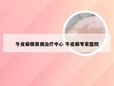 牛皮癣银屑病治疗中心 牛皮癣专家医院