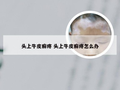 头上牛皮癣疼 头上牛皮癣疼怎么办