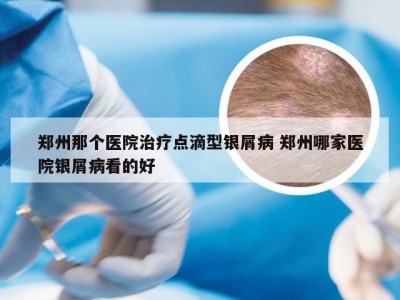 郑州那个医院治疗点滴型银屑病 郑州哪家医院银屑病看的好