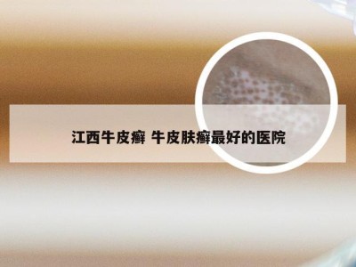 江西牛皮癣 牛皮肤癣最好的医院