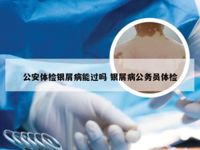 公安体检银屑病能过吗 银屑病公务员体检