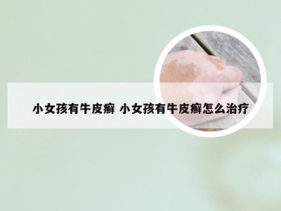 小女孩有牛皮癣 小女孩有牛皮癣怎么治疗