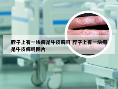 脖子上有一块癣是牛皮癣吗 脖子上有一块癣是牛皮癣吗图片