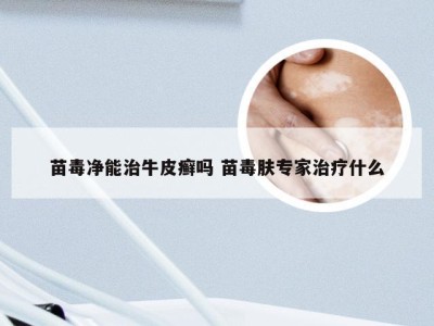 苗毒净能治牛皮癣吗 苗毒肤专家治疗什么