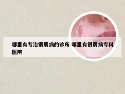 哪里有专治银屑病的诊所 哪里有银屑病专科医院