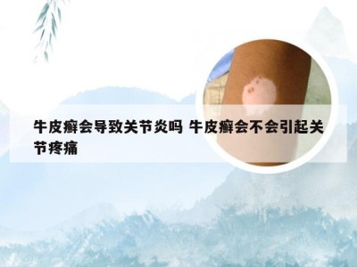 牛皮癣会导致关节炎吗 牛皮癣会不会引起关节疼痛