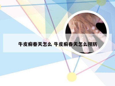 牛皮癣春天怎么 牛皮癣春天怎么预防
